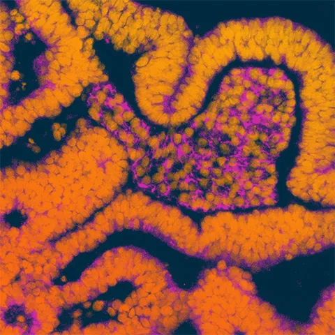 Drug-Resistant Infections