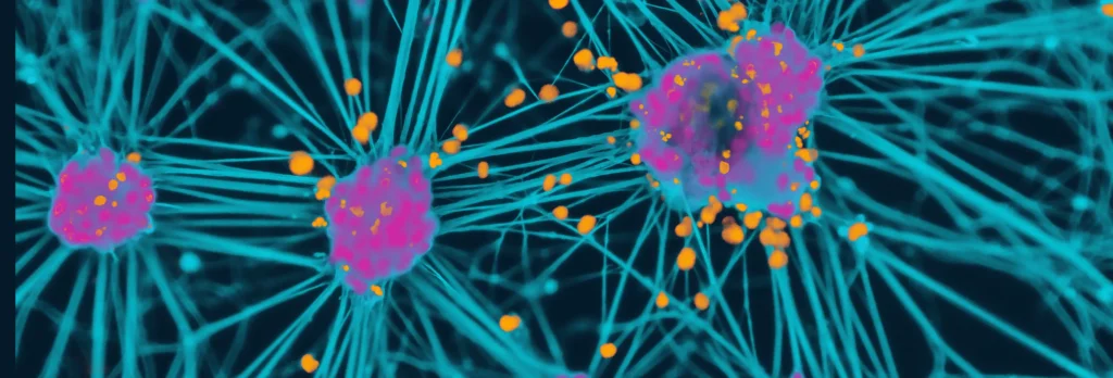 Parkinson’s Disease