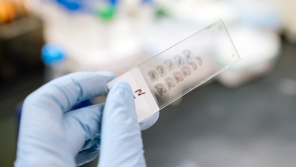 Combination of Two Cancer Drugs May Work Against Alzheimer’s