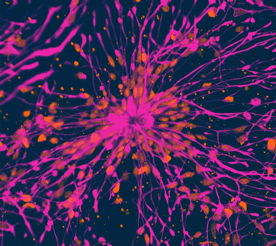 Alzheimer’s Disease