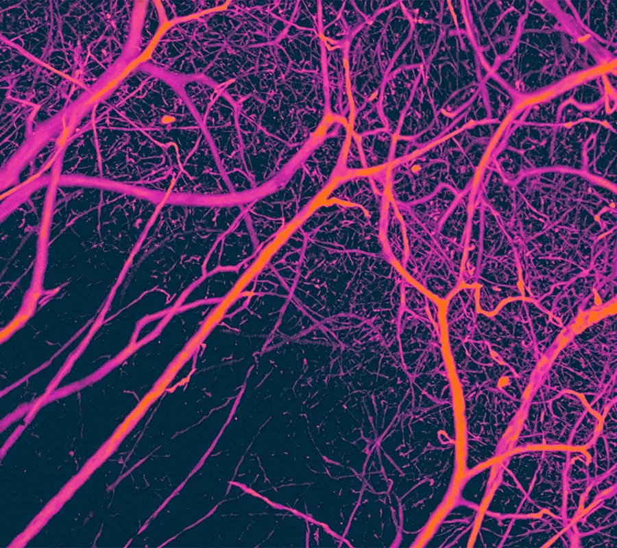Huntington’s Disease